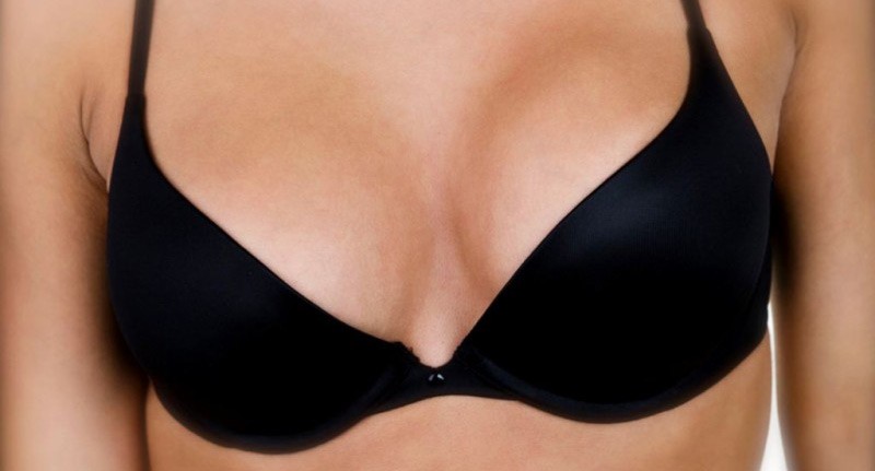 Before After Breast Augmentation, Breast Lift & Internal Bra/Mesh