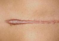 Treatment of post opp scars