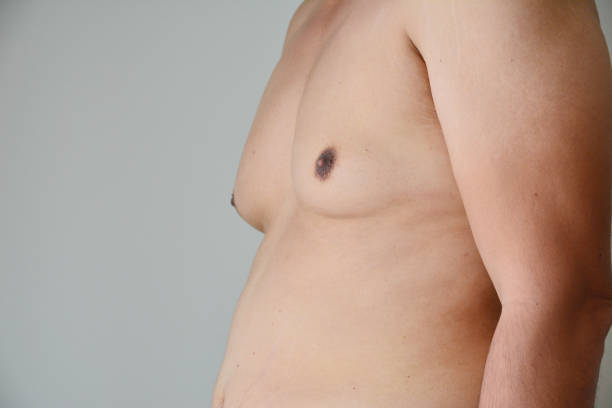 Gynecomastia Diagnosis and Solutions